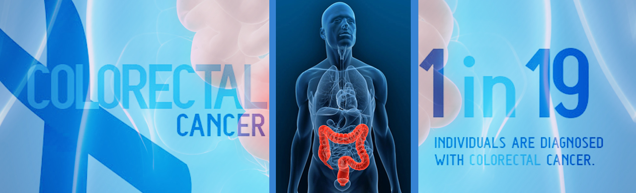 Colorectal Cancer